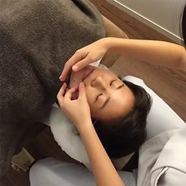 美容鍼